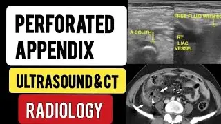 Perforated APPENDIX - Discussion - Radiology
