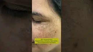 She was suffering from skin problems | Amazing results after 2 sittings🔥#shorts