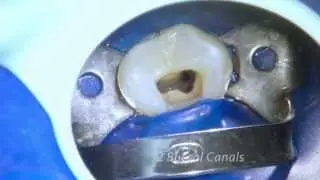 Endodontic Treatment  - Maxillary Premolar with 3 Canals