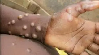Health segment: All you need to know about Monkey Virus and Marburg Virus | Breakfast Daily
