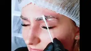 Reddish Eyebrows Old Pigment Removal with M Laser