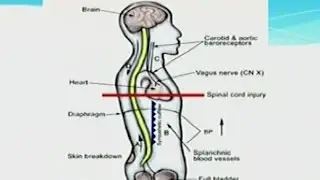 Autonomic Dysreflexia