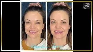 Restylane For Chin augmentation (Best) - Flawless Faces Med Spa