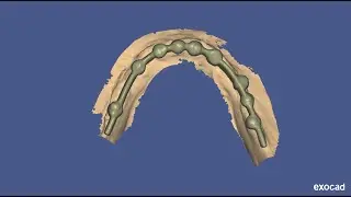 How to design bar for single piece implants in lower arch - best laser dental clinic