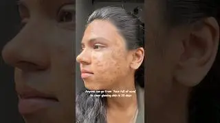 Say Goodbye to Tiny Bumps ✨ | Smooth, Glowing Skin Routine 💖 #Shorts