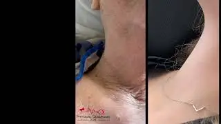 Corrigan&rsquo;s Pulse in Aortic Regurgitation &mdash; Bounding Carotid Pulse Explained