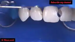 Class 3 composite restoration