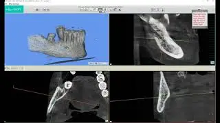 MSOFT Tutorial: Nerve Tracking (Part 5)