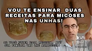 O MELHOR REM&Eacute;DIO CASEIRO DO MUNDO PARA MICOSE DE UNHA. 