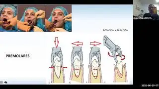 CACES CLASE EXODONCIA MANDIBULAR 22
