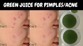 Get rid of Acne/Pimples with in Just 7 Days with this GREEN MAGICAL TONIC AYURVEDICMETHOD #Lavinlove
