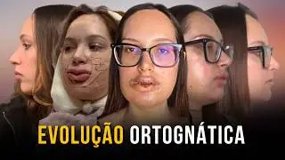 EVOLUÇÃO CIRURGIA ORTOGNÁTICA 30 DIAS