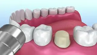 Repairing Compromised Teeth