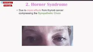 Thyroid Cancer Explain | @DRxMEDINFO #thyroid #cancer #drxmedinfo #video #health 