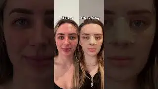 Cat Eye Surgery Before & After 👁️✨