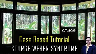 STURGE WEBER SYNDROME (CT- SCAN)  -  A CASE BASED TUTORIAL.