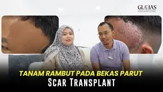 Tanam Rambut SMART™ FUE Atas Parut: Lihat Hasil Selepas 2 Minggu di GLOJAS!