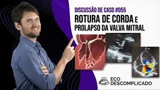 EcoDescomplicado - Discussão de caso #055 - Rotura de corda e prolapso da Valva Mitral