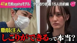 【クマ取り密着】目の下のクマが目立つ41歳モデル、クリニックを巡り選んだ治療は…【クマ取り密着15人目前編】#目の下のたるみ#美容整形#裏ハムラ#脂肪注入#湘南美容クリニック