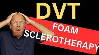 Ultrasound Guided Foam Sclerotherapy & Blood Clots: The Truth About DVT Risk; Facts versus Fiction