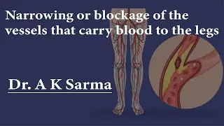 Narrowing or blockage of the vessels that carry blood to the legs