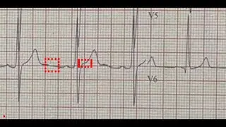 PRACTICE ECG 1