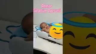 Celah bibir sebelum - sesudah operasi... #celahbibir #sumbing