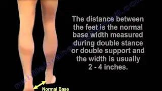 Wide Based Gait, Myelopathy Gait - Everything You Need To Know - Dr. Nabil Ebraheim