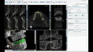 BSP4.11: Completely Automatic CT Tooth Segmentation