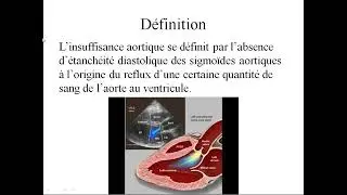 Insuffisance aortique 🤩 explication la plus claire 🤩 Pr  H  ZOUZOU #ECN