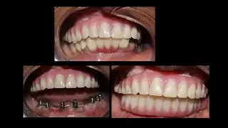 How to add Bredent Gum addition for 3d printed prosthesis (lower)!!