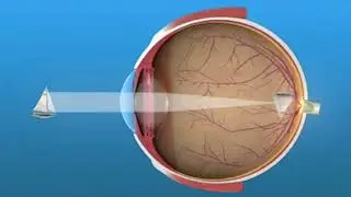 What is Refractive Error?