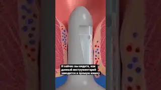 Процедура HAL. Полное видео на канале #shorts