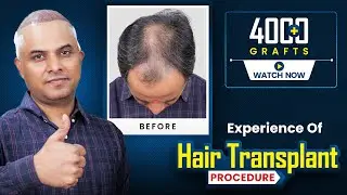 From Hair Loss to Confidence |Painless Hair Transplant Experience |Hairfree & Hairgrow Surat Results