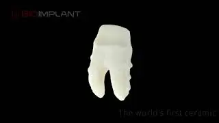 IMMEDIATE CERAMIC DENTAL IMPLANT