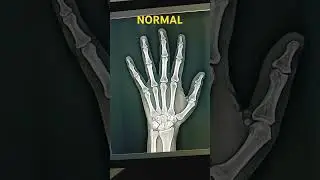 xray wrist hand ap normal bone Short video like subscribe please