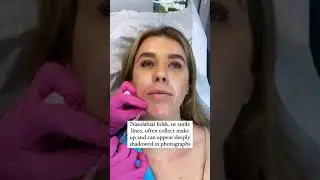 NASOLABIAL FOLDS! 🥰❤️ #FILLER