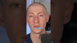 How Many Grafts Will I Need For A Hair Transplant?