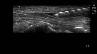 Wrist Ultrasound: Carpal Tunnel Hydrodissection (long axis)