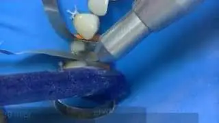 Ceramic Onlay Adhesive Cementation: Sandblasting and etching
