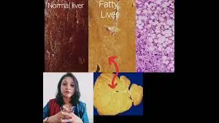 Fatty liver -An introduction and Gross morphology.By Dr.Suchita Patel PATH in2 minutes