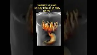 Home Remedy for Heartburn | Quick Relief Tips and Effective Solutions