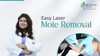 Best Way To Remove Unwanted Mole | Mole Removal | Laser Mole Removal | Mole Treatment