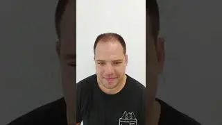 Hair transplant in Turkey Hair Academy İstanbul / Turkey ✅👌 Result: 8 months later