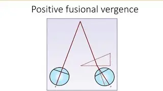 Orthopics series 5 : Positive fusional vergence ( PFV )