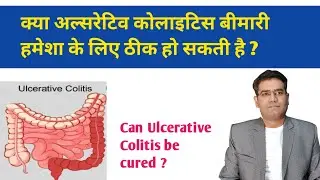 Can Ulcerative Colitis be Cured? | क्या अल्सरेटिव कोलाइटिस ठीक हो सकता है