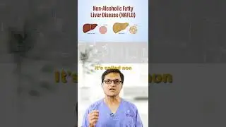 Fatty Liver Can Kill &mdash; Quietly. #fattyliver #liver #livercancer #cirrhosis #livercirrhosis #cancer