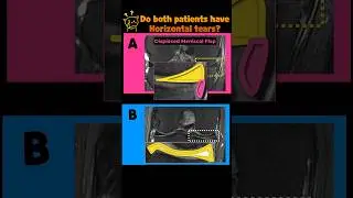 (Fig 1-B.17) Horizontal tear versus horizontal flap tear