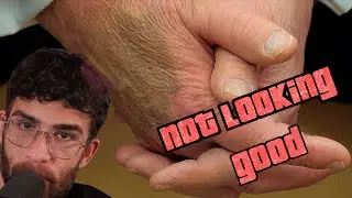 Trump explains his hand bruises - bad health | Hasanabi Reacts