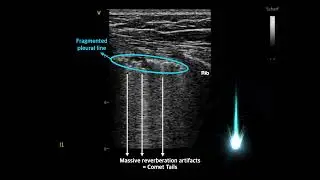 〖Ultrasound〗How to describe artifacts in lung ultrasound